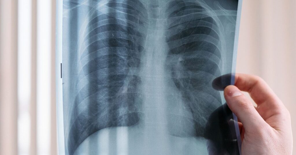 Mão segurando uma radiografia de tórax contra a luz, com os dois pulmões à vista, exame do câncer de pulmão tratado com o osimertinibe (Tagrisso) pedido ao plano de saúde